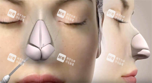 隆鼻手術(shù)動(dòng)畫(huà)圖