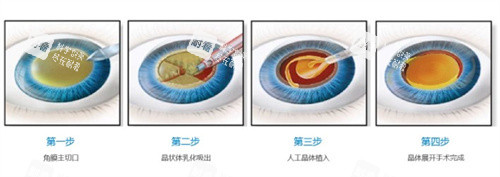 白內(nèi)障手術(shù)過程