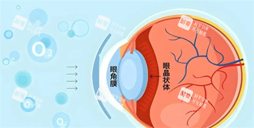 角膜塑形鏡佩戴方法