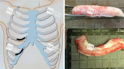 肋骨隆鼻細(xì)節(jié)圖
