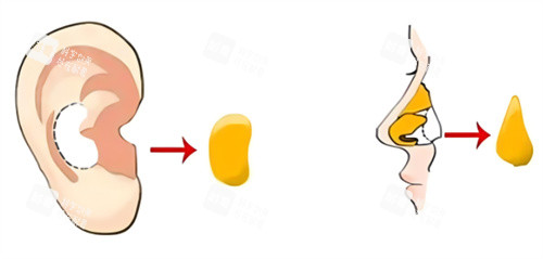 隆鼻耳軟骨圖示