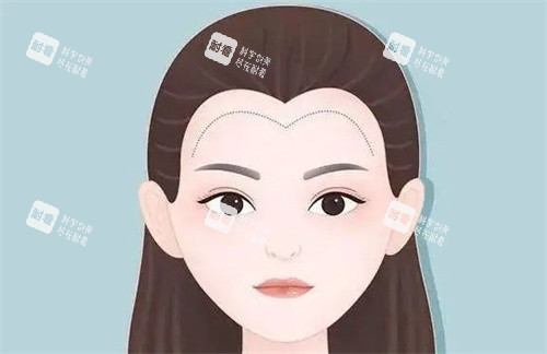 植發(fā)際線卡通 植發(fā)際線卡通