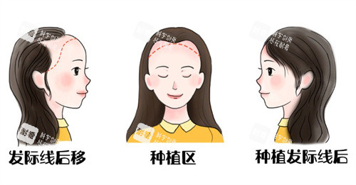 發(fā)際線后遺種植前后 發(fā)際線后遺種植前后