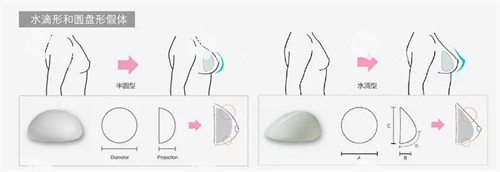 假體隆胸過程圖