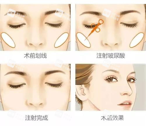 玻尿酸前后注射示意圖