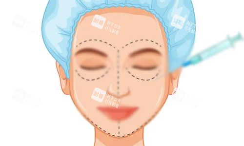 玻尿酸全臉填充展示