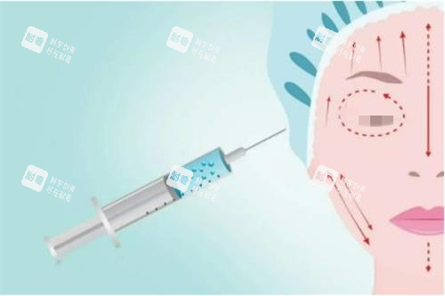 注射玻尿酸示意圖