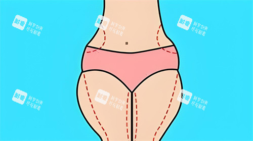 腿部吸脂手術(shù)吸脂部位動畫圖 腿部吸脂手術(shù)吸脂部位動畫圖