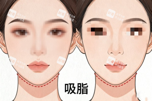 下巴做吸脂前后對比圖 下巴做吸脂前后對比圖