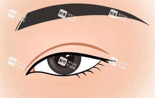 雙眼皮手術(shù)