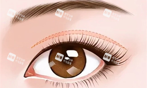 雙眼皮特寫展示圖