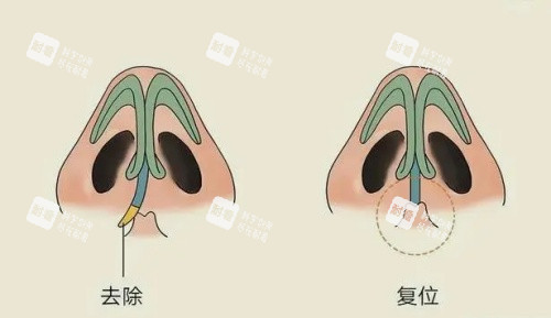 歪鼻修復(fù)矯正