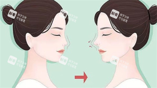 鼻修復(fù)對比