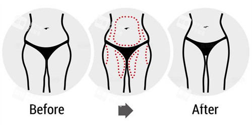 腰腹大腿吸脂前后對(duì)比圖