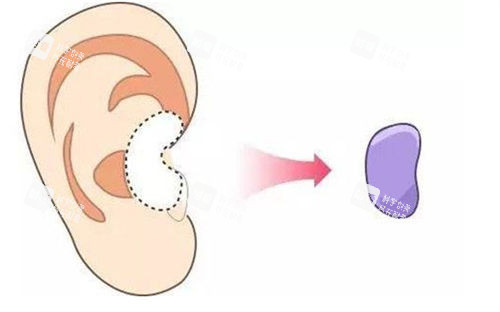 耳軟骨隆鼻移除位置展示圖