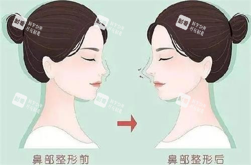 液態(tài)隆鼻前后的區(qū)別