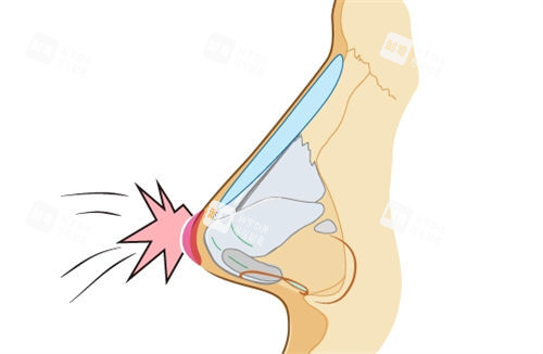 隆鼻假體鼻背動(dòng)畫(huà)展示圖