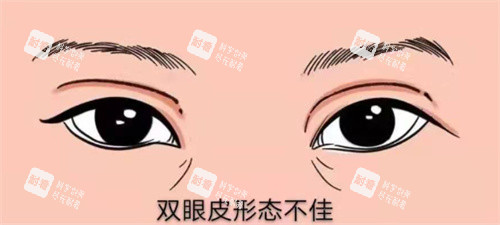 雙眼皮修復(fù)示圖