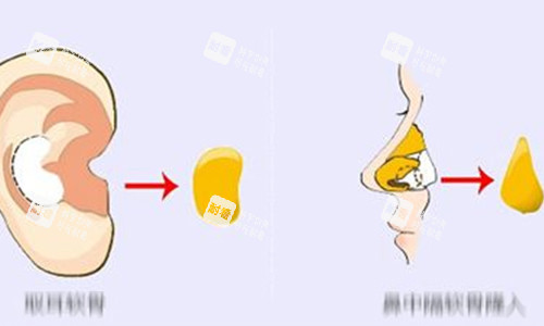 耳軟骨隆鼻動畫示意圖