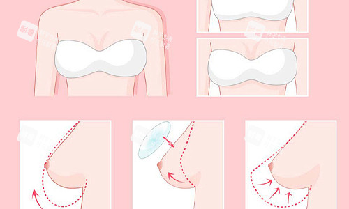 德國寶儷假體隆胸大揭秘！獨特優(yōu)勢、真實手感與術(shù)后驚艷結(jié)果全知曉