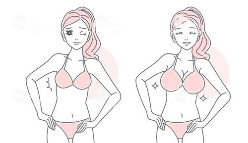隆胸手術(shù)前后