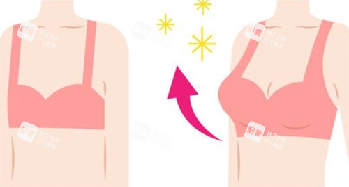 隆胸前后對(duì)比