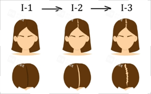 輕度脫發(fā)素材