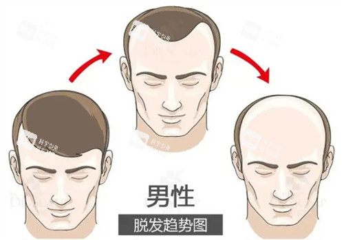 脫發(fā)趨勢圖