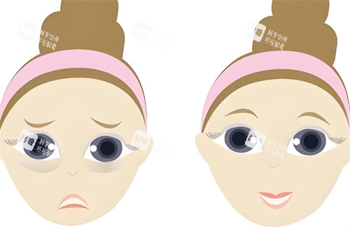 中年祛眼袋前后對比