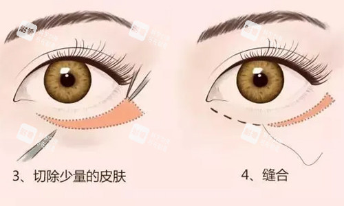 外切祛眼袋展示圖