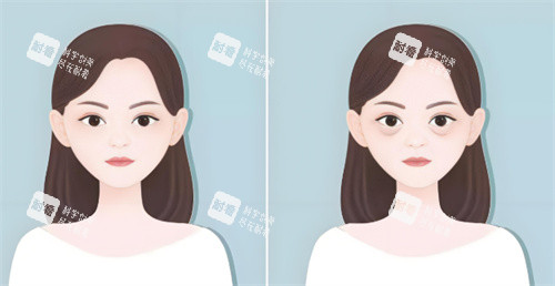 祛眼袋手術前后對比