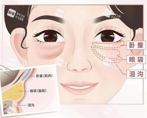 眼袋圖片展示