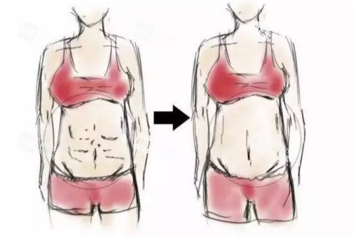 腹壁成型術(shù)卡通對比圖