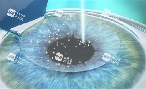 全飛秒手術原理