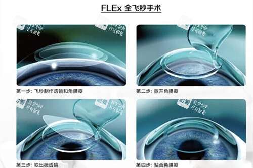 全飛秒手術過程示意圖