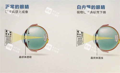 正常眼睛和白內(nèi)障眼睛的對比圖