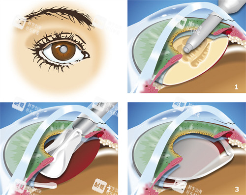 超聲乳化白內(nèi)障吸除中
