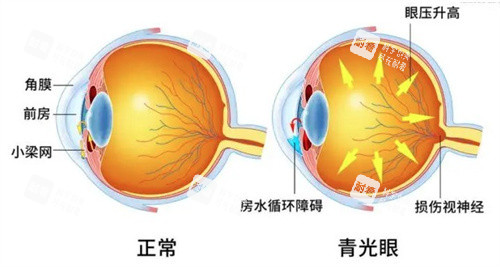 急性閉角型青光眼