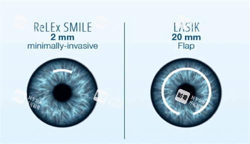 全飛秒和半飛秒手術對比圖 全飛秒和半飛秒手術對比圖