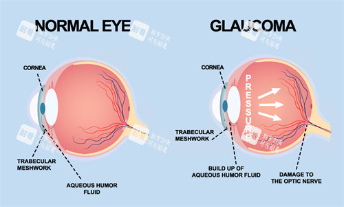 青光眼動畫演示圖 青光眼動畫演示圖