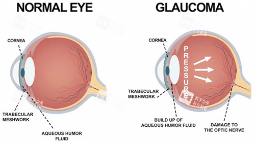 青光眼和正常眼睛對比 青光眼和正常眼睛對比
