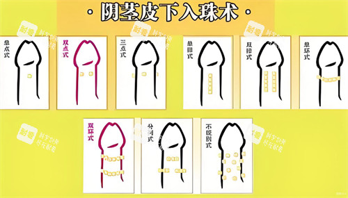 陰莖皮下入珠術(shù) 陰莖皮下入珠術(shù)