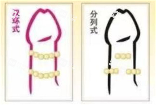 陰莖入珠術(shù)款式有哪些 陰莖入珠術(shù)款式有哪些