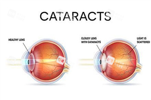 健康眼與白內(nèi)障眼對(duì)比