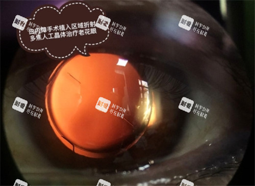 白內(nèi)障手術(shù)細節(jié)圖 (2) 白內(nèi)障手術(shù)細節(jié)圖 (2)