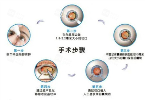 白內(nèi)障手術(shù)步驟 白內(nèi)障手術(shù)步驟