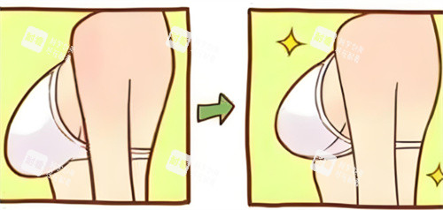 乳房下垂內(nèi)衣穿著對(duì)比