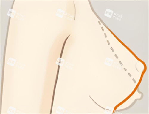 乳房下垂矯正輪廓對(duì)比
