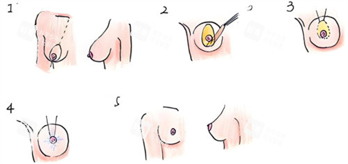 乳房下垂矯正術(shù)過(guò)程