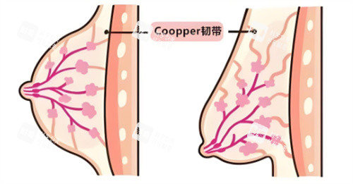 乳房下垂韌帶組織對(duì)比